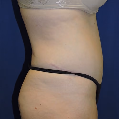 Tummy Tuck before and after, case 9648 - Cool Springs Plastic Surgery