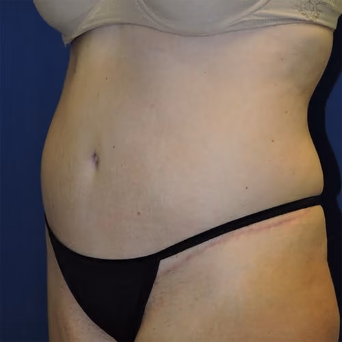 Tummy Tuck before and after, case 9648 - Cool Springs Plastic Surgery