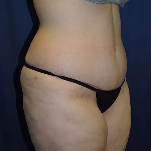 Tummy Tuck before and after, case 9685 - Cool Springs Plastic Surgery