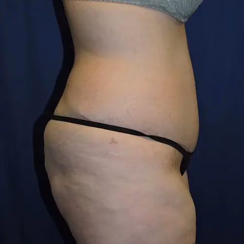 Tummy Tuck before and after, case 9685 - Cool Springs Plastic Surgery