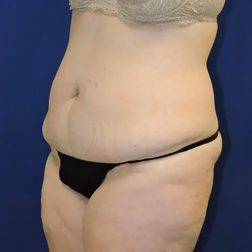 Tummy Tuck before and after, case 9685 - Cool Springs Plastic Surgery