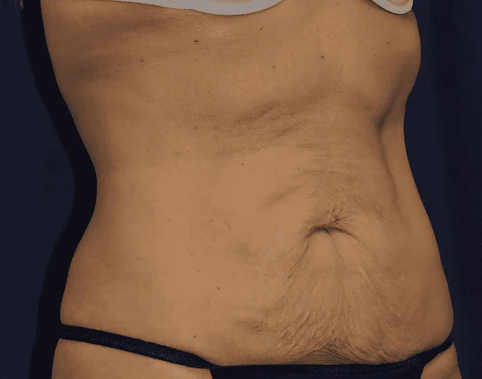 Liposuction before and after, case 12842 - Cool Springs Plastic Surgery