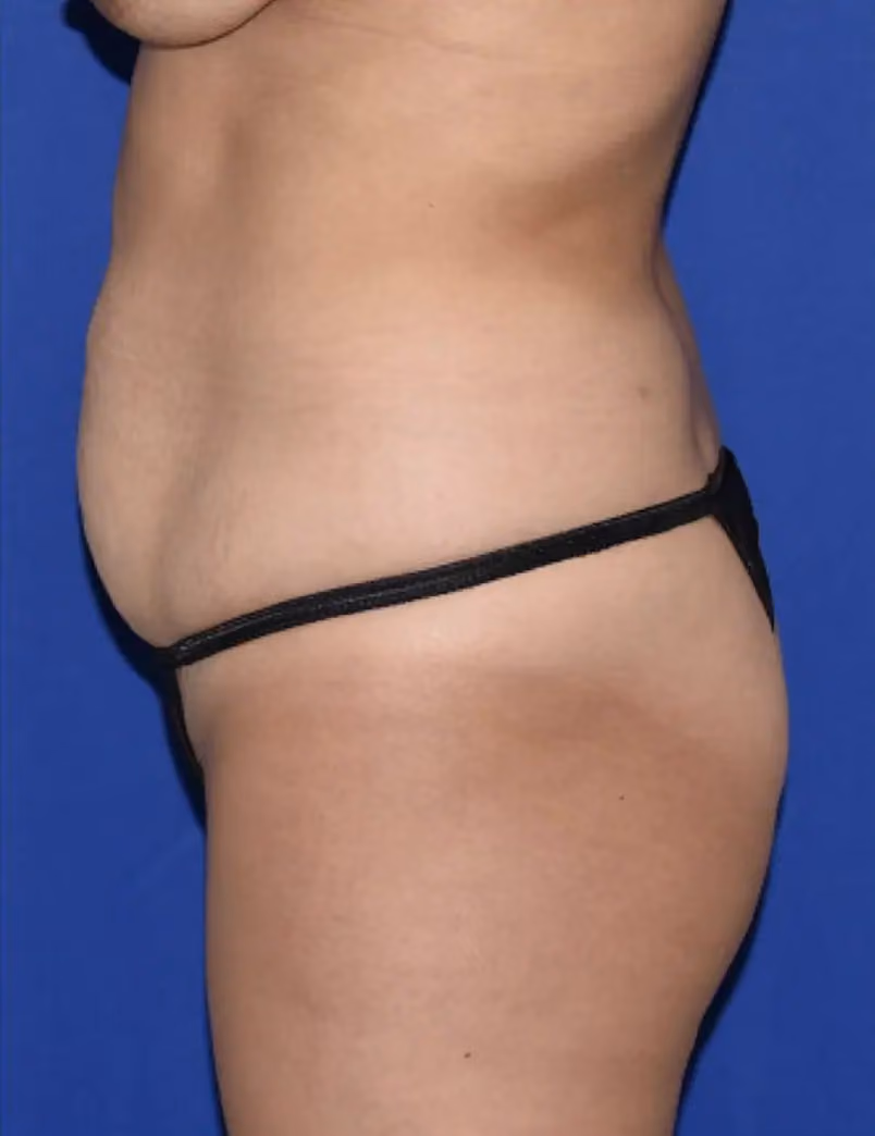 Tummy Tuck before and after, Dr. Sarosiek, case 12971 - Cool Springs Plastic Surgery