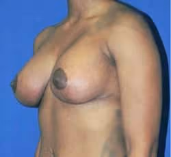 Breast Lift + Augmentation before and after, case 1813 - Cool Springs Plastic Surgery