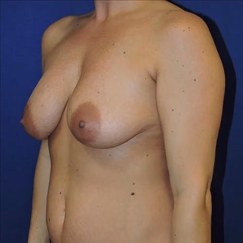 Breast Lift + Augmentation before and after, case 2315 - Cool Springs Plastic Surgery