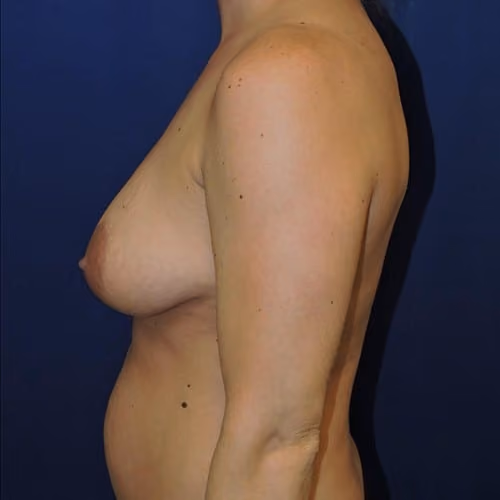 Breast Lift + Augmentation before and after, case 2315 - Cool Springs Plastic Surgery