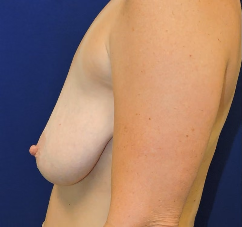 Breast Lift + Augmentation before and after, case 2864 - Cool Springs Plastic Surgery