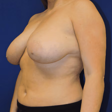 Breast Lift + Augmentation before and after, case 2921 - Cool Springs Plastic Surgery