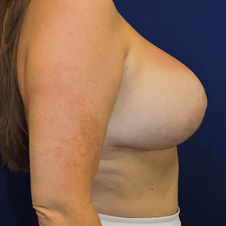 Breast Lift + Augmentation before and after, case 2921 - Cool Springs Plastic Surgery