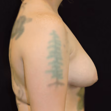 Breast Lift + Augmentation before and after, case 3339 - Cool Springs Plastic Surgery