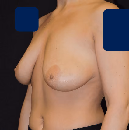 Breast Lift + Augmentation before and after, case 3378 - Cool Springs Plastic Surgery