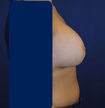 Breast Lift + Augmentation before and after, case 3378 - Cool Springs Plastic Surgery