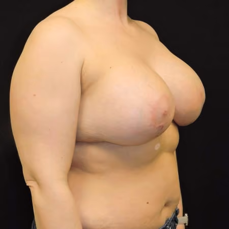 Breast Lift + Augmentation before and after, case 3637 - Cool Springs Plastic Surgery