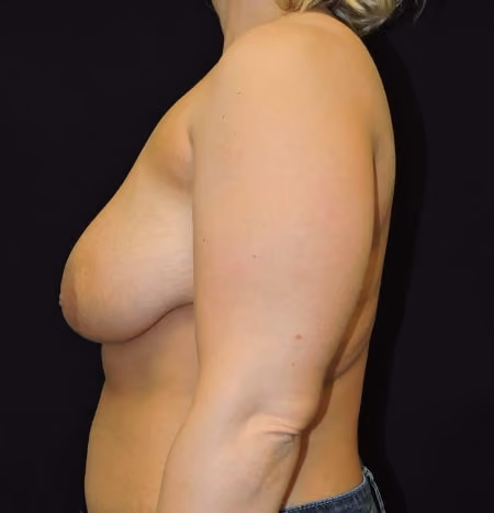 Breast Lift + Augmentation before and after, case 3637 - Cool Springs Plastic Surgery