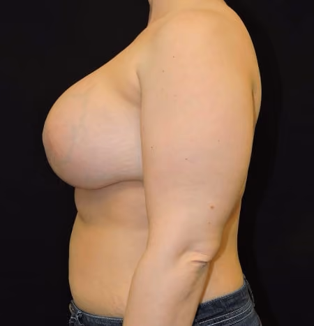 Breast Lift + Augmentation before and after, case 3637 - Cool Springs Plastic Surgery