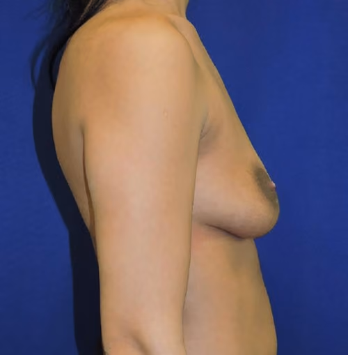 Breast Lift + Augmentation before and after, case 4087 - Cool Springs Plastic Surgery
