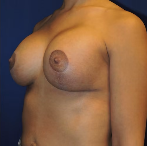 Breast Lift + Augmentation before and after, case 4087 - Cool Springs Plastic Surgery