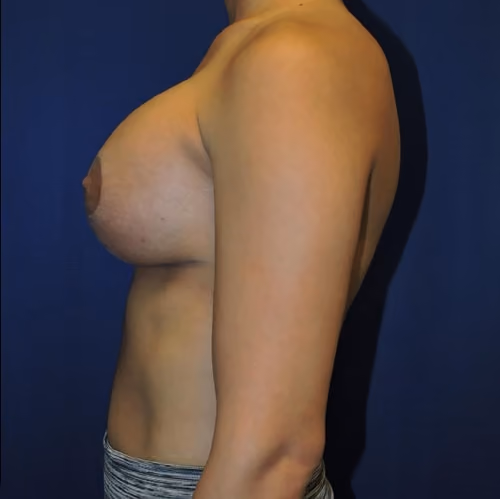 Breast Lift + Augmentation before and after, case 4087 - Cool Springs Plastic Surgery