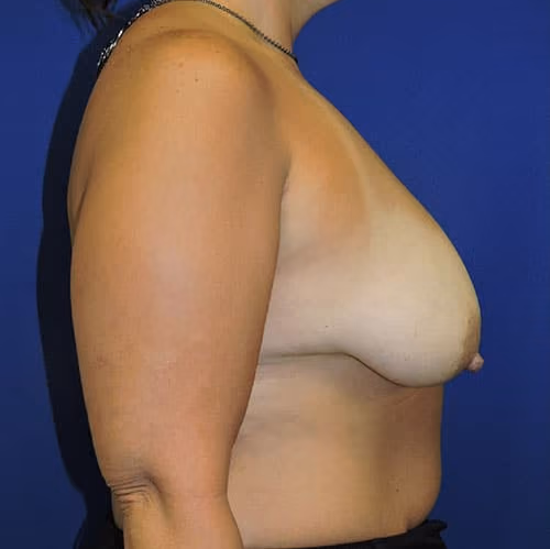 Breast Lift + Augmentation before and after, case 4264 - Cool Springs Plastic Surgery