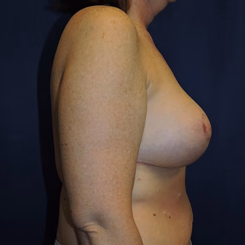 Breast Lift + Augmentation before and after, case 4596 - Cool Springs Plastic Surgery