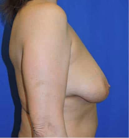 Breast Lift + Augmentation before and after, case 4637 - Cool Springs Plastic Surgery