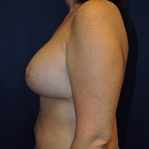 Breast Lift + Augmentation before and after, case 4596 - Cool Springs Plastic Surgery
