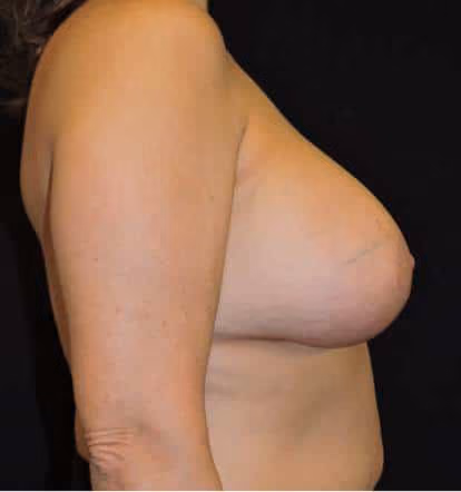 Breast Lift + Augmentation before and after, case 4637 - Cool Springs Plastic Surgery