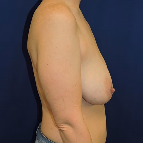 Breast Lift + Augmentation before and after, case 4753 - Cool Springs Plastic Surgery