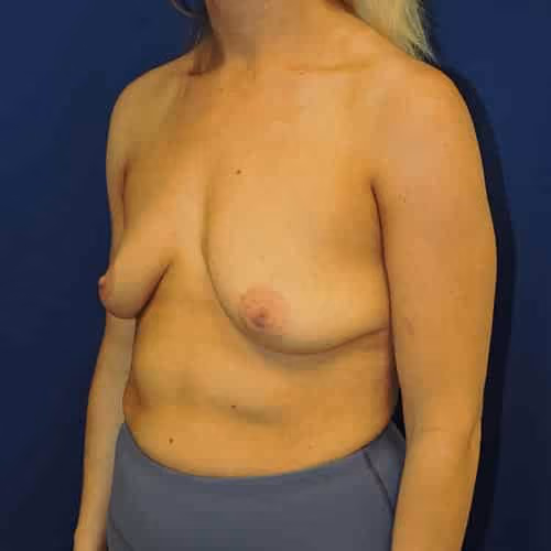 Breast Lift + Augmentation before and after, case 4829 - Cool Springs Plastic Surgery