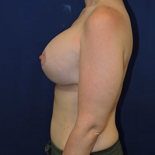 Breast Lift + Augmentation before and after, case 4753 - Cool Springs Plastic Surgery