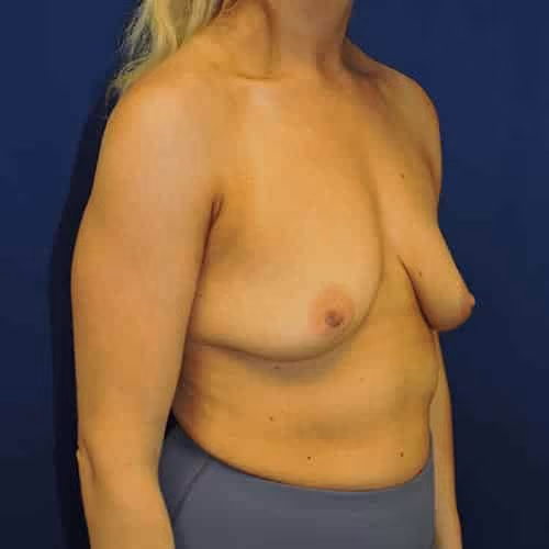 Breast Lift + Augmentation before and after, case 4829 - Cool Springs Plastic Surgery