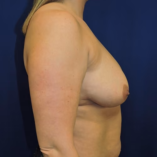 Breast Lift + Augmentation before and after, case 4906 - Cool Springs Plastic Surgery