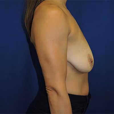 Breast Lift + Augmentation before and after, case 4937 - Cool Springs Plastic Surgery
