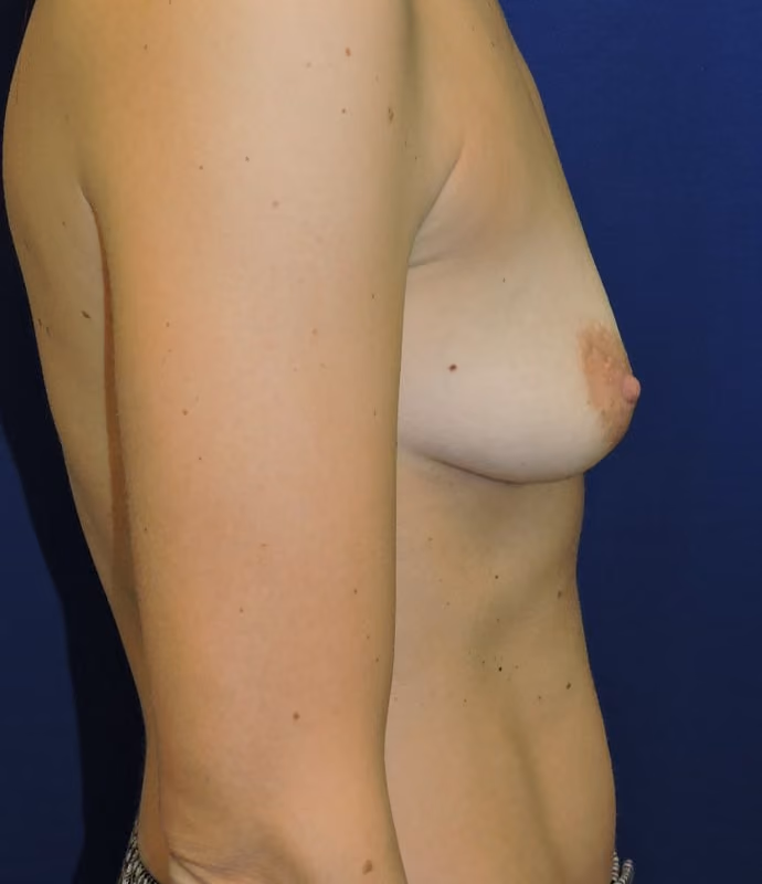 Breast Lift + Augmentation before and after, case 5220 - Cool Springs Plastic Surgery