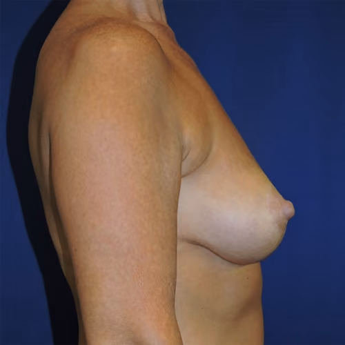 Breast Lift + Augmentation before and after, case 5751 - Cool Springs Plastic Surgery