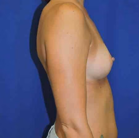 Breast Augmentation before and after, case 1777 - Cool Springs Plastic Surgery