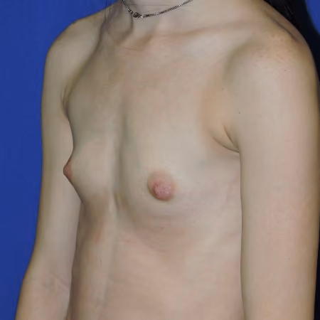 Breast Augmentation before and after, case 1978 - Cool Springs Plastic Surgery