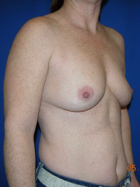 Breast Augmentation before and after, case 2481 - Cool Springs Plastic Surgery