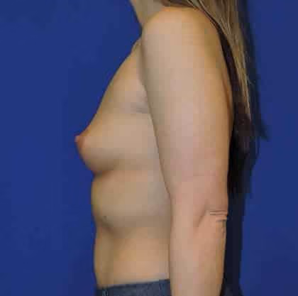 Breast Augmentation before and after, case 2727 - Cool Springs Plastic Surgery