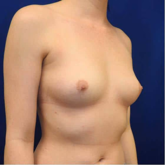 Breast Augmentation before and after, case 3564 - Cool Springs Plastic Surgery