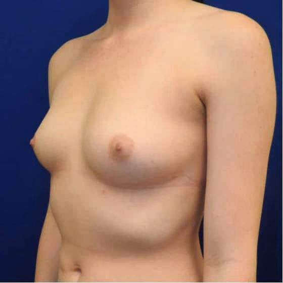 Breast Augmentation before and after, case 3564 - Cool Springs Plastic Surgery