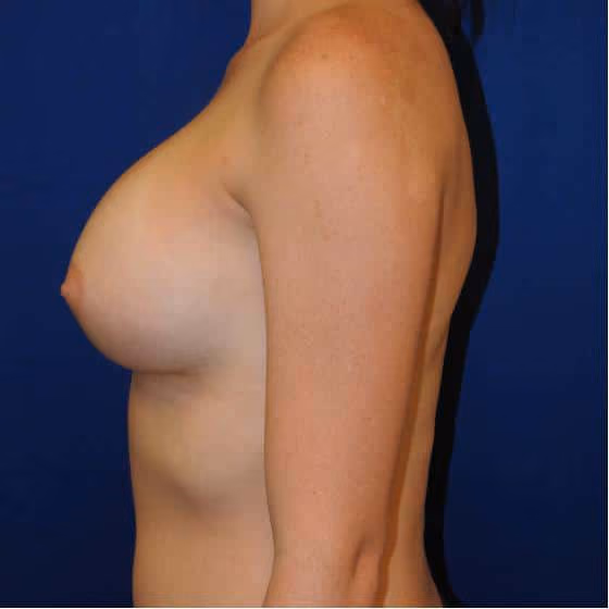 Breast Augmentation before and after, case 3564 - Cool Springs Plastic Surgery