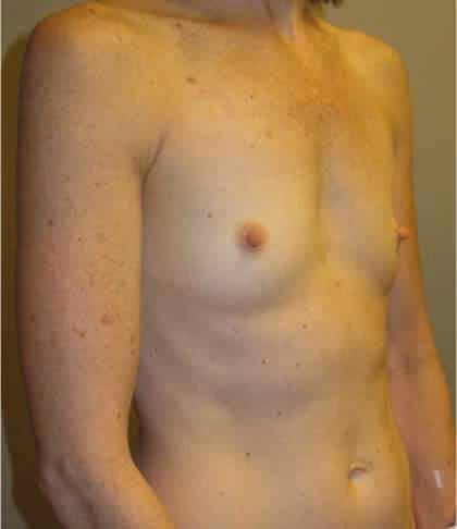 Breast Augmentation before and after, case 4234 - Cool Springs Plastic Surgery