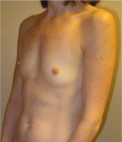 Breast Augmentation before and after, case 4234 - Cool Springs Plastic Surgery