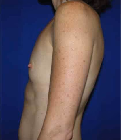 Breast Augmentation before and after, case 4234 - Cool Springs Plastic Surgery