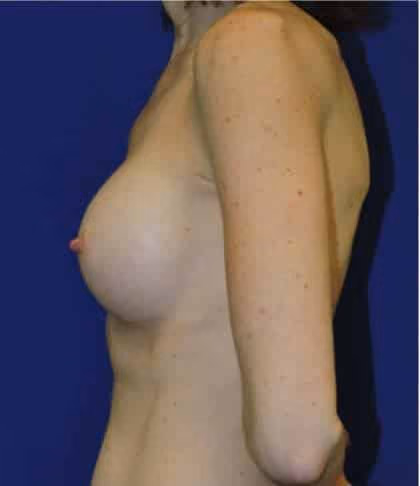 Breast Augmentation before and after, case 4234 - Cool Springs Plastic Surgery