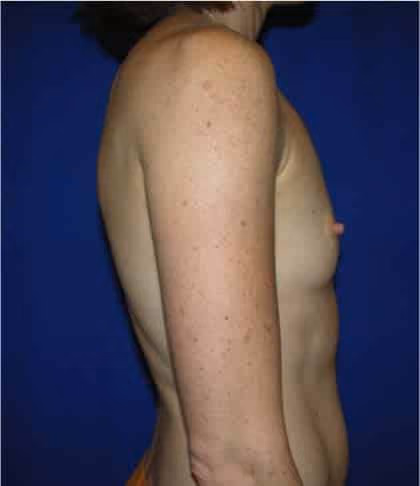 Breast Augmentation before and after, case 4234 - Cool Springs Plastic Surgery