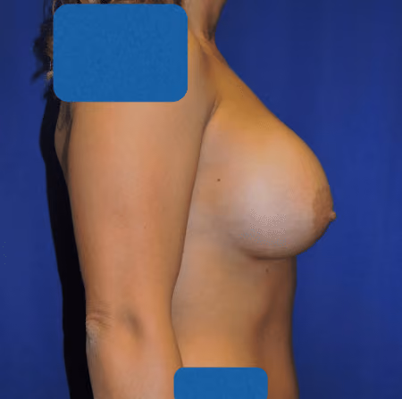 Breast Augmentation before and after, case 4294 - Cool Springs Plastic Surgery