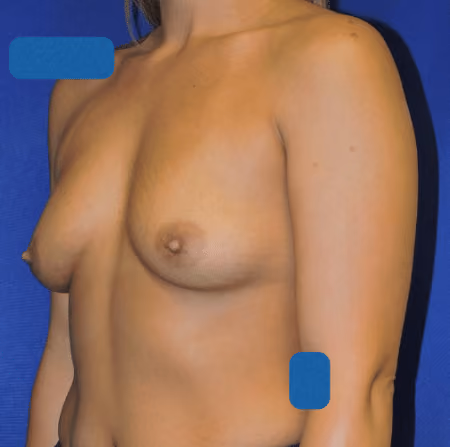 Breast Augmentation before and after, case 4294 - Cool Springs Plastic Surgery