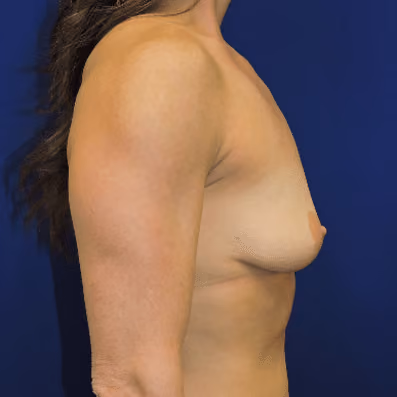 Breast Augmentation before and after, case 4384 - Cool Springs Plastic Surgery